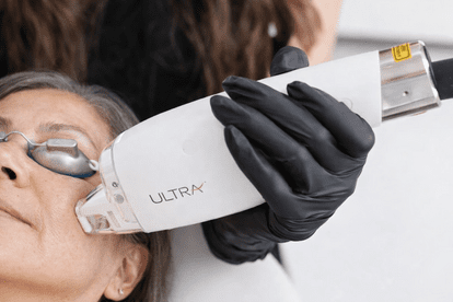 Humaderme Patient during LaseMD Ultra™ treatment